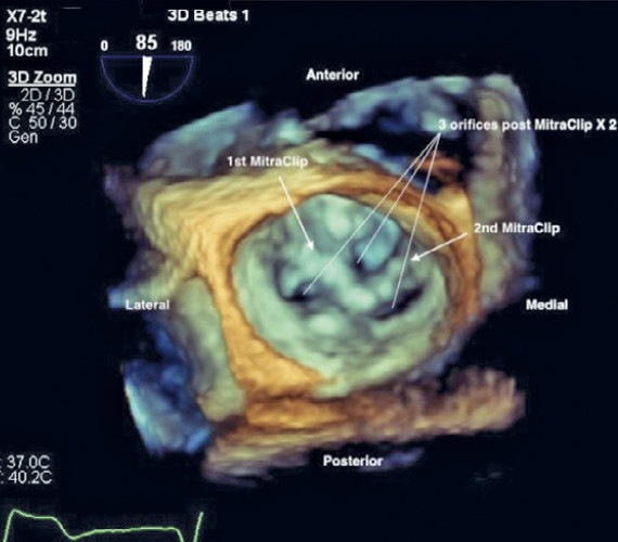 Classic crush and DK crush stenting techniques - EuroIntervention