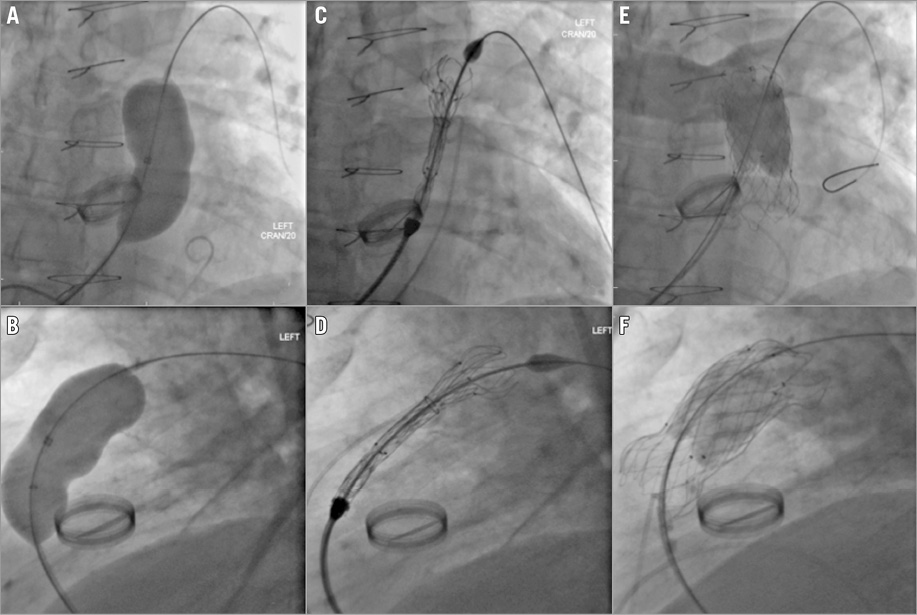 Early European experience with the Venus P-valve®: filling the gap in ...