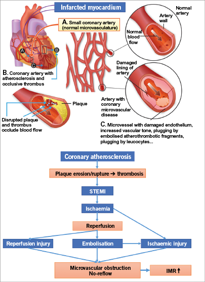 Prevention of coronary microvascular plugging: the next target in STEMI ...