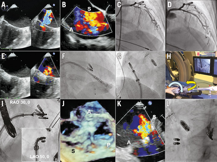 First Percutaneous Micra Leadless Pacemaker Implantation And Tricuspid