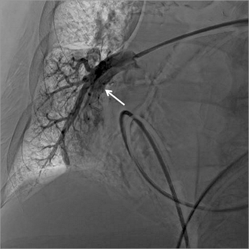 Pulmonary Rupture How should I treat a pulmonary artery rupture occurring during a right ...