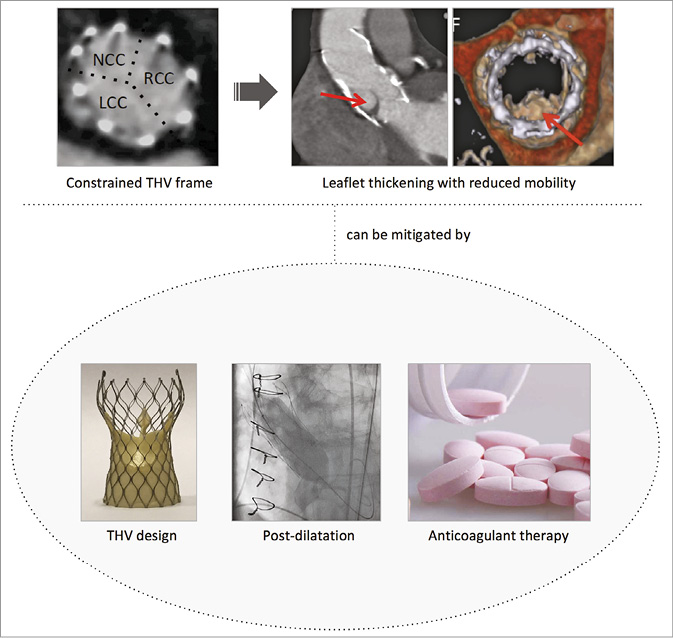 Subclinical leaflet thickening and stent frame geometry in self