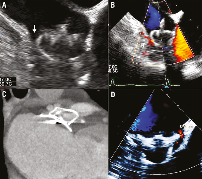 Residual leaks following percutaneous left atrial appendage occlusion