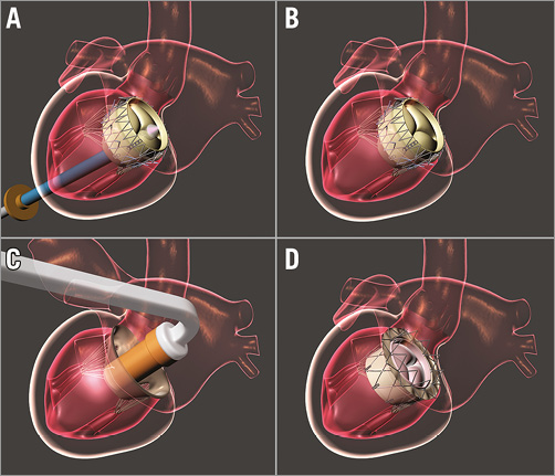 Transcatheter Mitral Valve Replacement With The NaviGate Stent In A ...