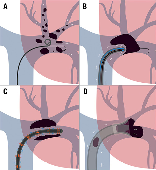 Catheterbased therapies in acute pulmonary embolism EuroIntervention