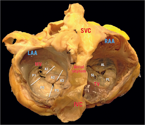 Compare and contrast tricuspid and mitral valve anatomy: interventional ...