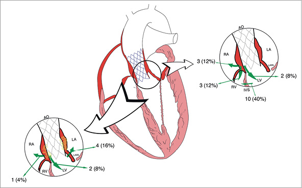 Intracardiac shunts following transcatheter aortic valve implantation ...