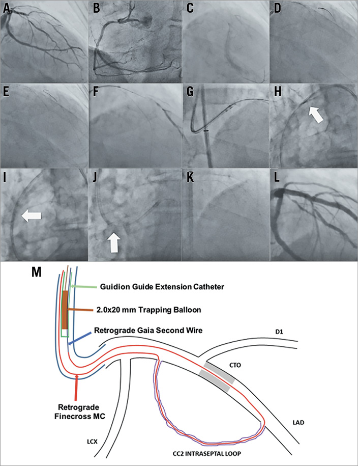Single guiding catheter retrograde CTO recanalisation facilitated by ...