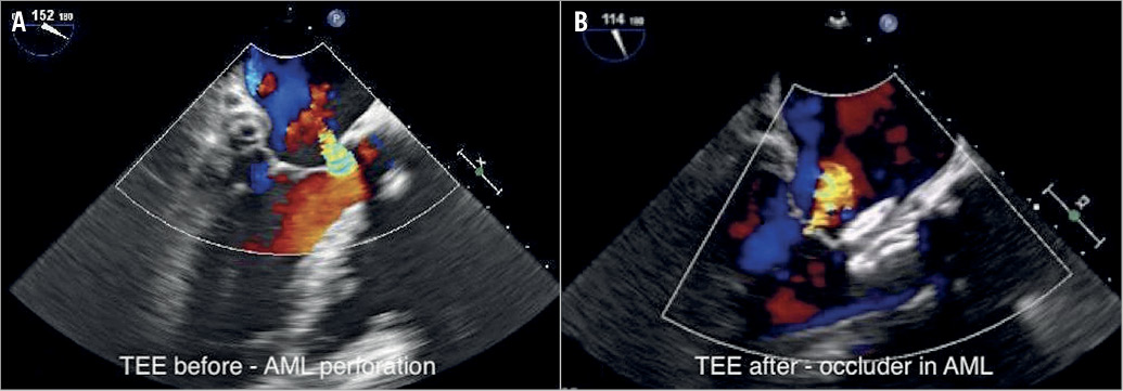 Percutaneous treatment of anterior mitral leaflet perforation using an ...