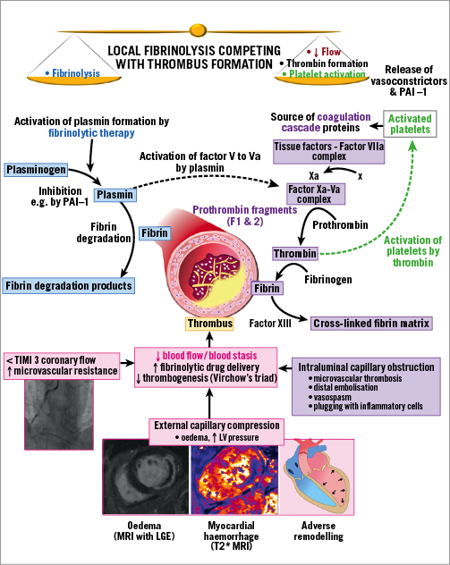 Failed myocardial reperfusion during primary PCI: an unmet therapeutic ...