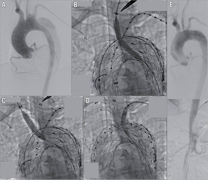 In situ diode laser fenestration of aortic arch stent grafts during ...