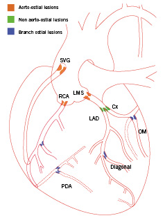 Percutaneous coronary intervention of ostial lesions - EuroIntervention