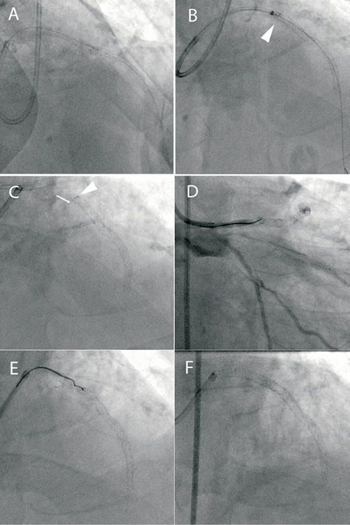 stent using a guideliner