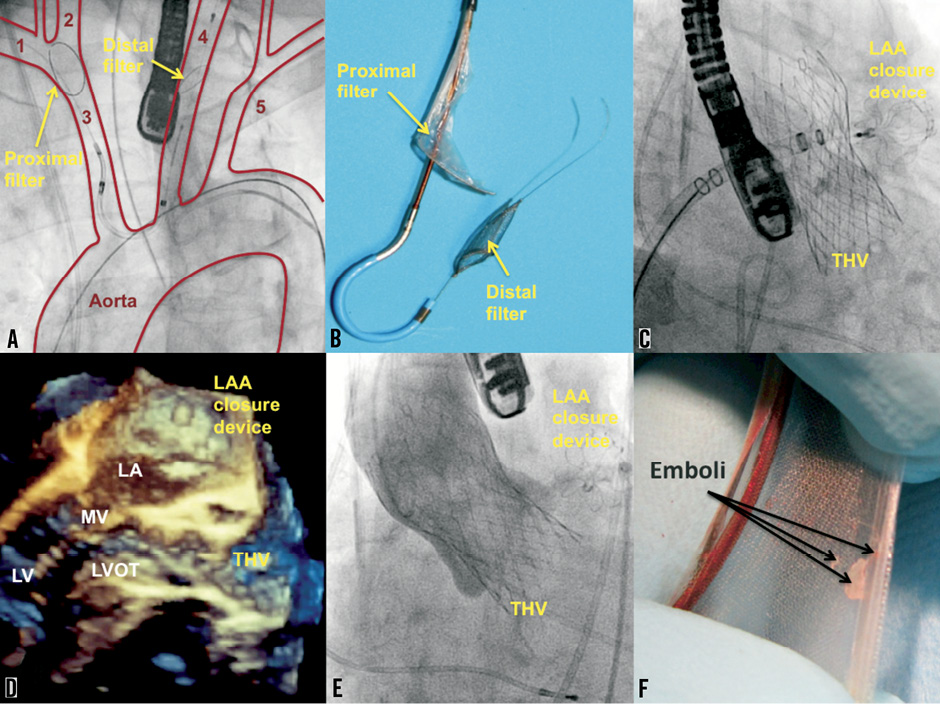 Transcatheter Aortic Valve Implantation And Closure Of The Left Atrial ...