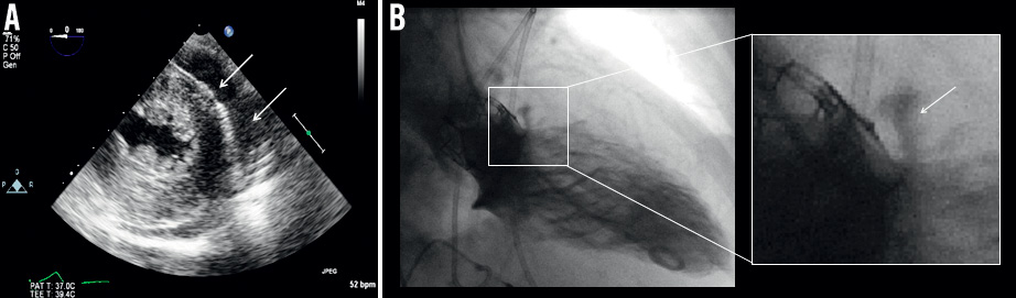 How should I treat acute aortic annulus rupture during transcatheter ...