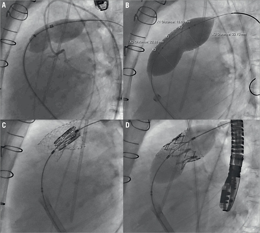 Early valve failure in a firstinman implant with an Edwards SAPIEN XT