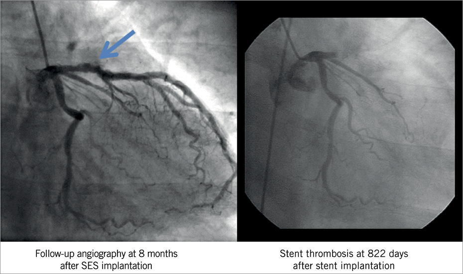 Peri-stent contrast staining and very late stent thrombosis after ...