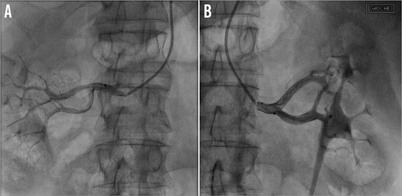 First report of transradial renal denervation with the dedicated ...