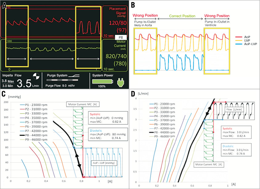 Tools & Techniques Clinical Percutaneous catheterbased left