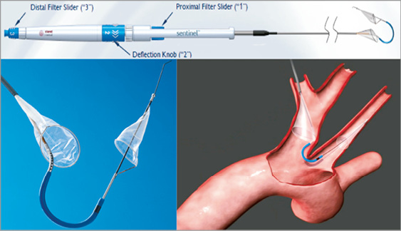 Tools and Techniques - Clinical: Embolic protection devices in ...