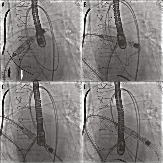 Percutaneous transfemoral-transseptal implantation of a second ...