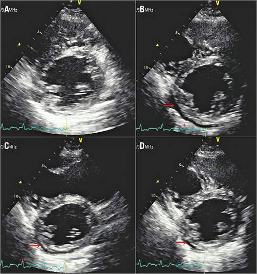 trivial pericardial effusion