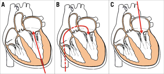 Transcatheter mitral valve replacement device landscape