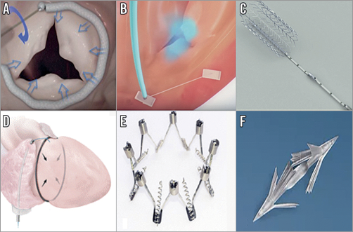 Transcatheter Treatment Of Tricuspid Regurgitation (focusing On Current 