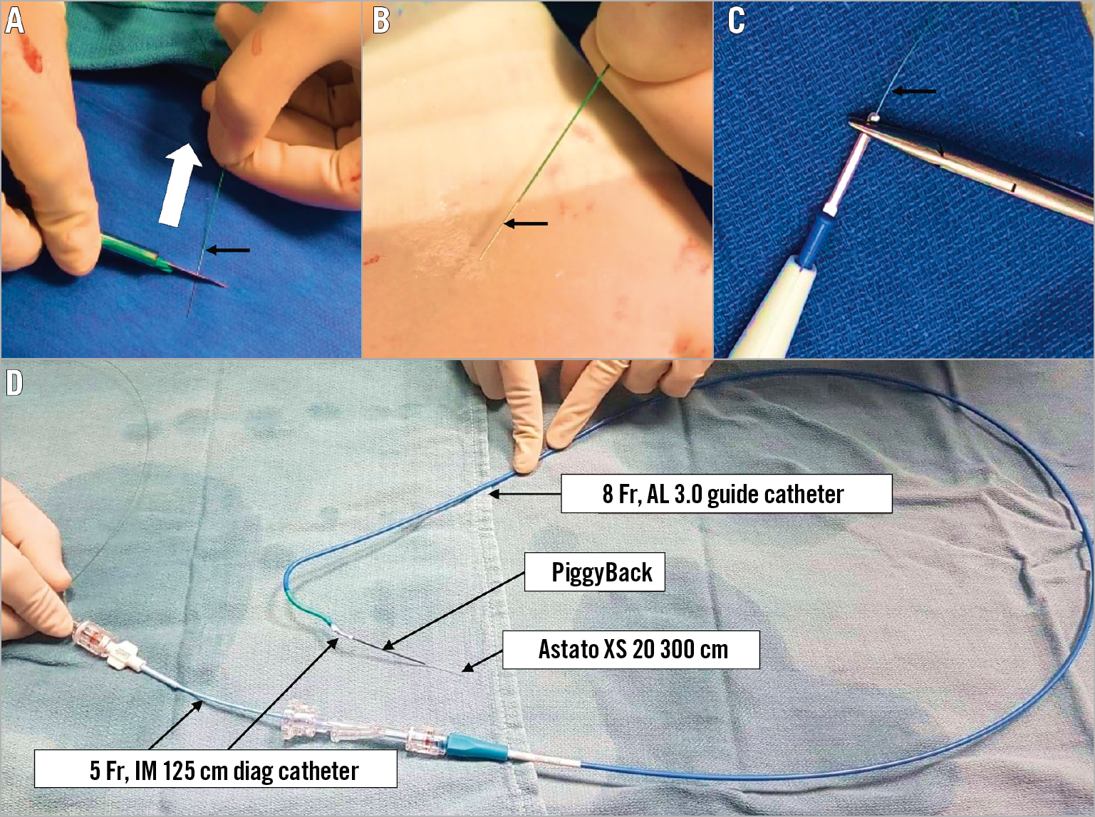 Bioprosthetic or native aortic scallop intentional laceration to prevent iatrogenic coronary