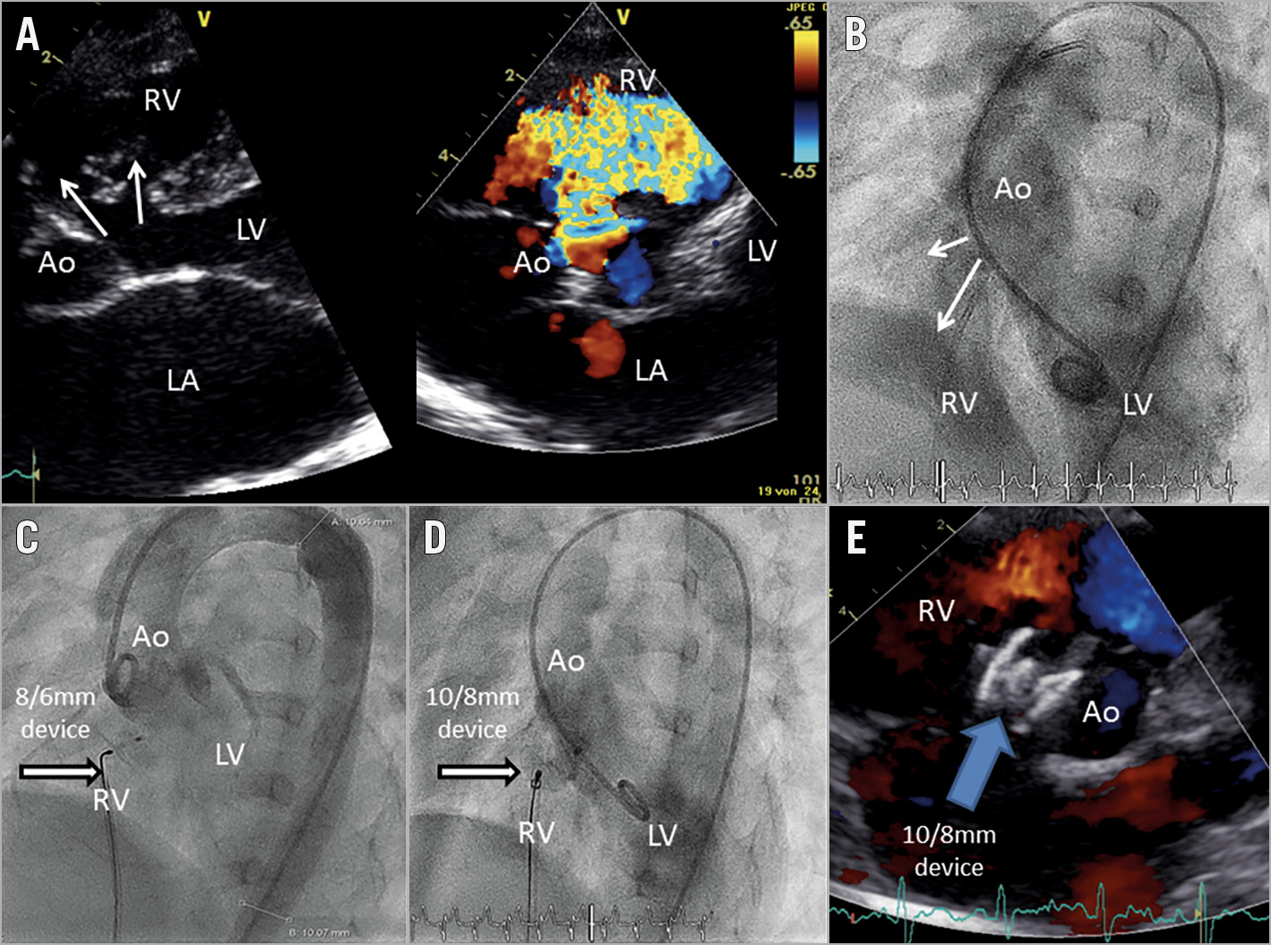 First European experience of percutaneous closure of ventricular septal