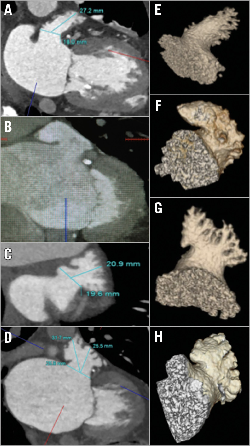 Ehra Eapci Expert Consensus Statement On Catheter Based Left Atrial Appendage Occlusion An Update Eurointervention