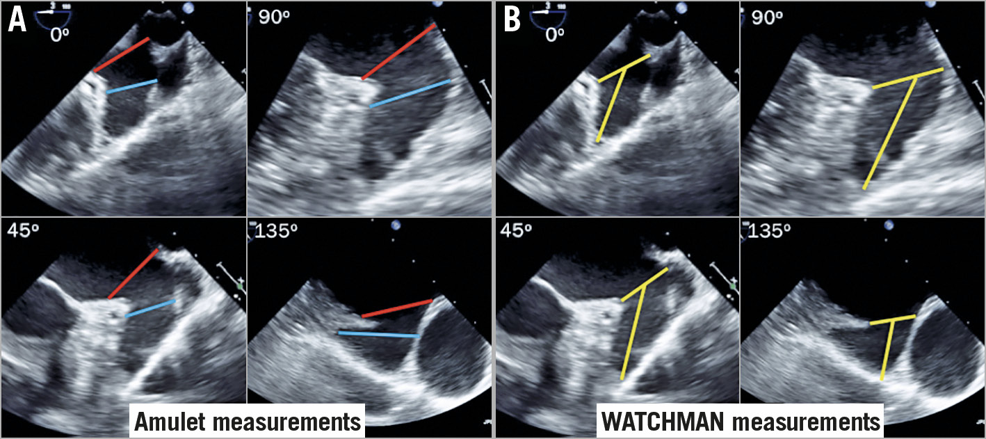 Ehra Eapci Expert Consensus Statement On Catheter Based Left Atrial Appendage Occlusion An Update Eurointervention