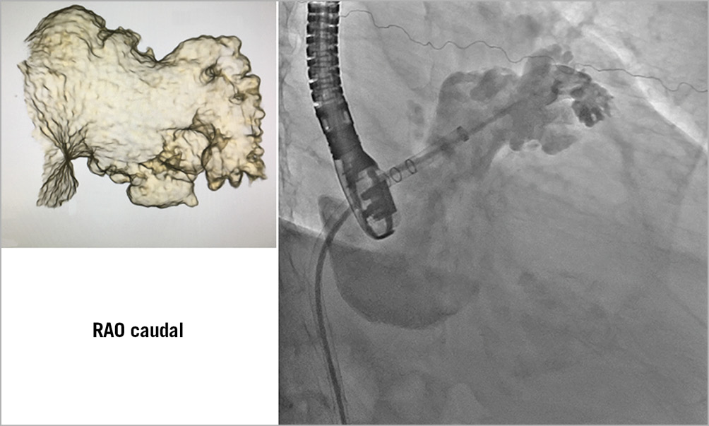 Ehra Eapci Expert Consensus Statement On Catheter Based Left Atrial Appendage Occlusion An Update Eurointervention