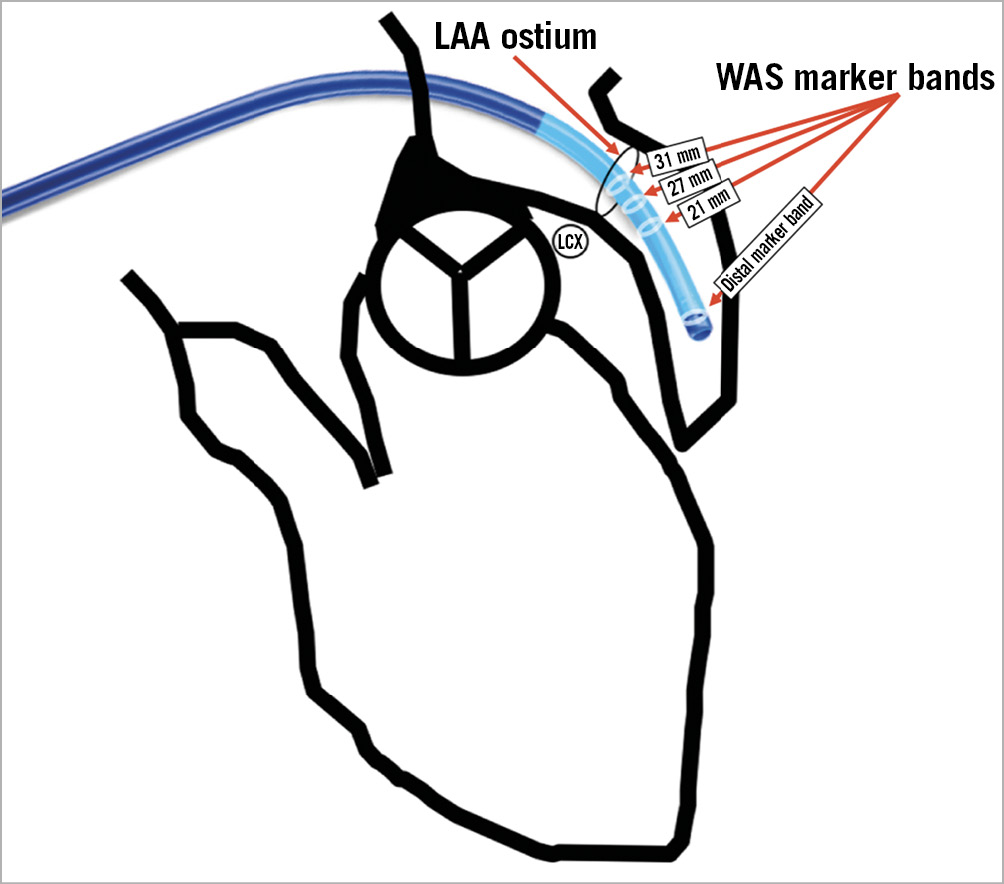 Ehra Eapci Expert Consensus Statement On Catheter Based Left Atrial Appendage Occlusion An Update Eurointervention