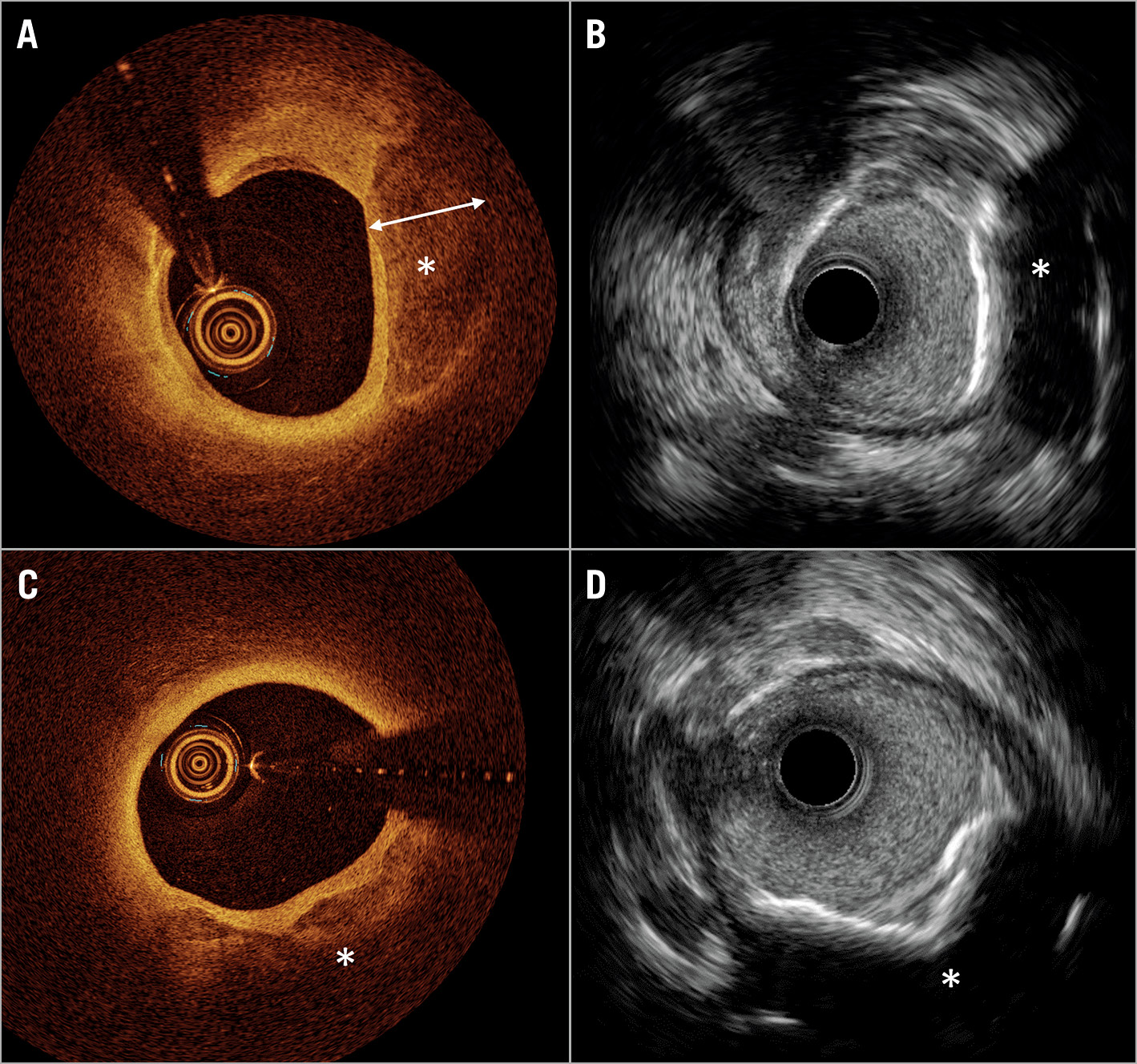 TCT-24. Combined Near-Infrared Spectroscopic and Intravascular Ultrasound  Assessment of Coronary Plaque Burden and Lipid Pools: Validation with  Histology