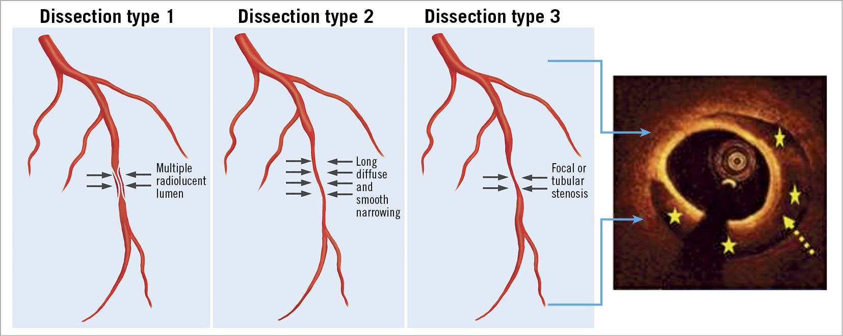 Homogenous, clear-cut, 3-h-old lesion of transmural coagulation