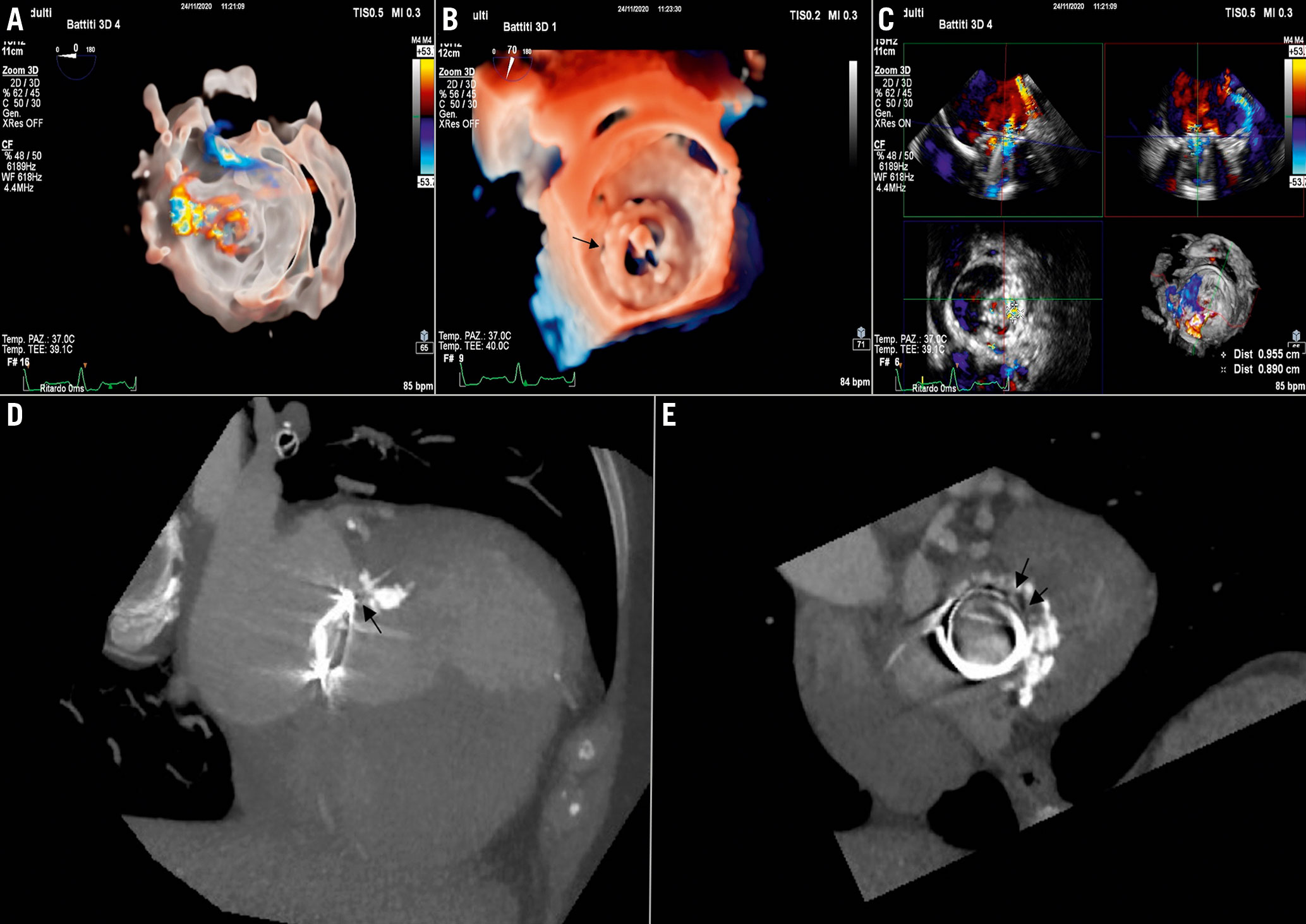 Transthoracic Echocardiographic Images Obtained after Cardiac  Catheterization 