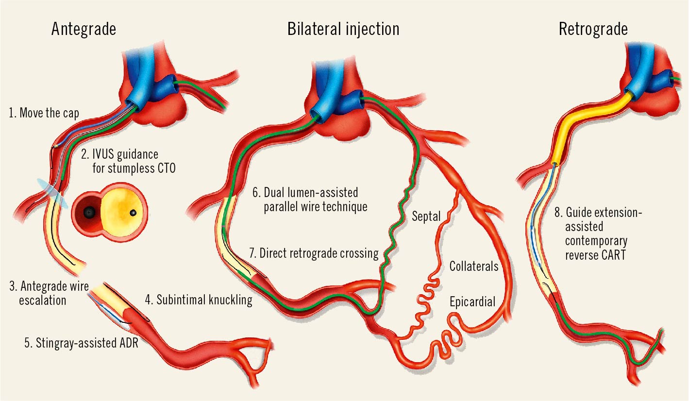 Roadmap Fusion Imaging in Percutaneous Coronary Intervention