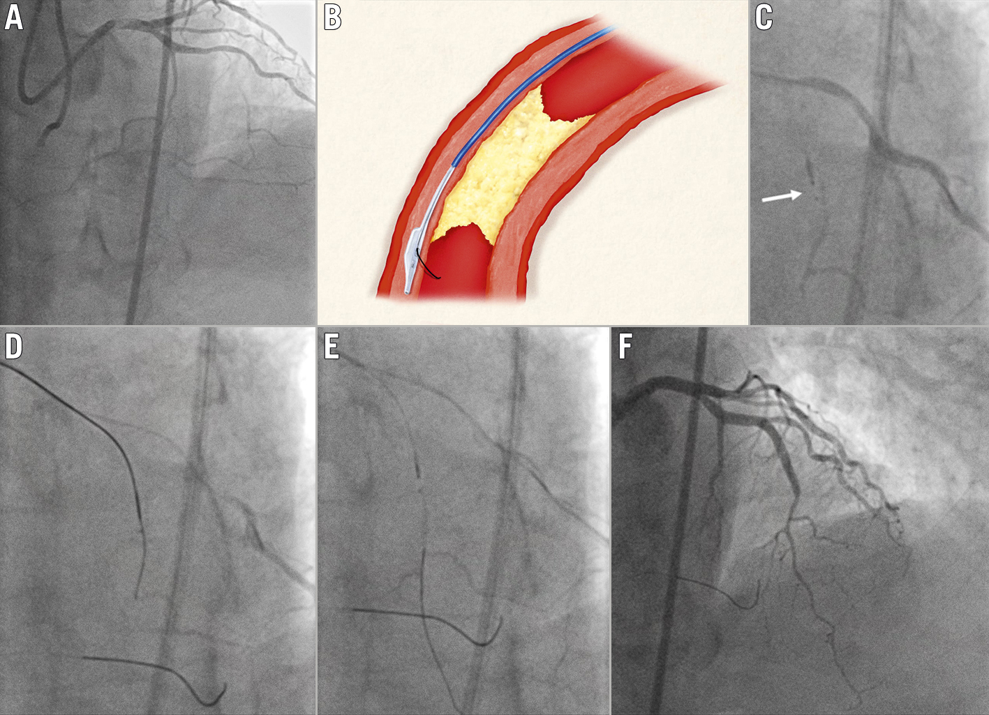 Roadmap Fusion Imaging in Percutaneous Coronary Intervention Reduces Contrast  Medium Exposure Irrespective of Investigator's Experience Level