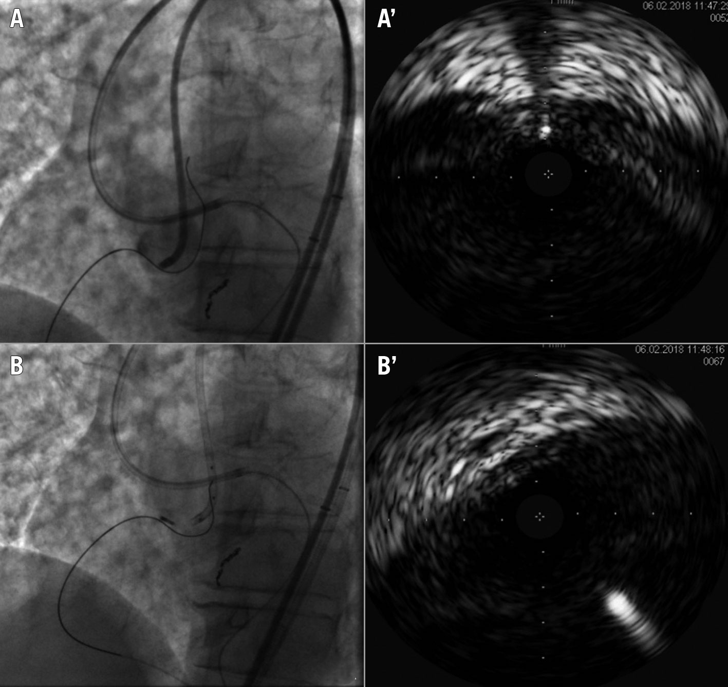 Recanalisation of coronary chronic total occlusions - EuroIntervention