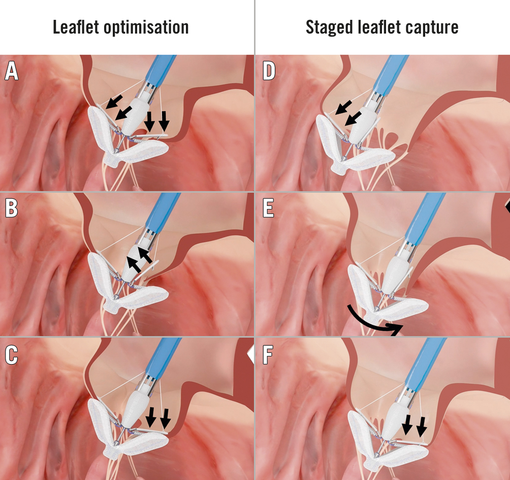 percutaneous mitral valve replacement