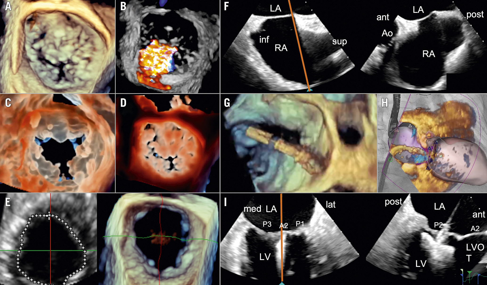 FDA Advisors' Recommendation on Renal Denervation Hinges on