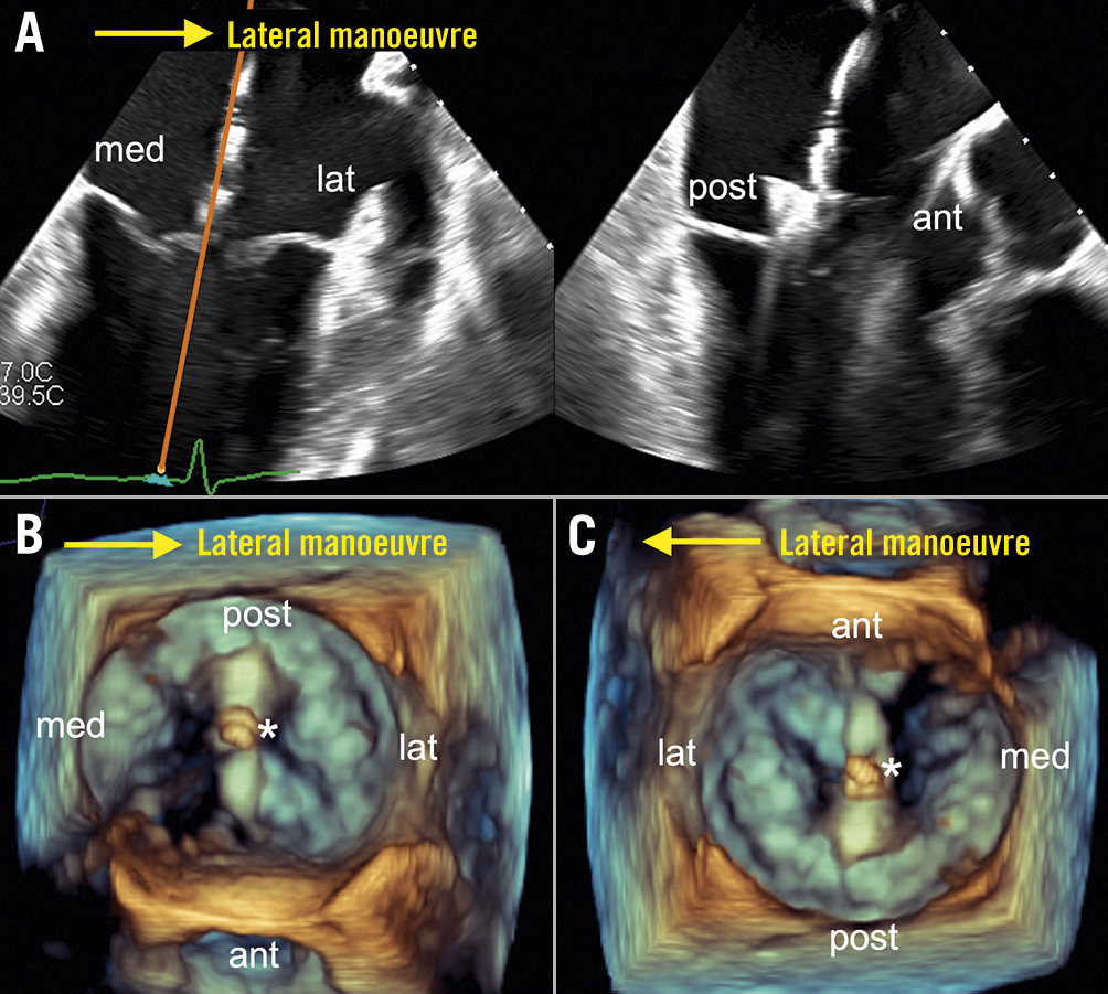 FDA Advisors' Recommendation on Renal Denervation Hinges on