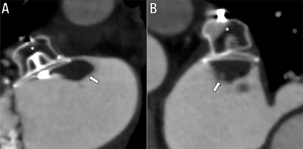 Left Atrial Appendage Occlusion - EuroIntervention