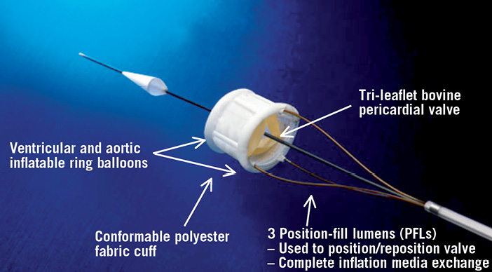 Direct Flow Medical Valve - Eurointervention