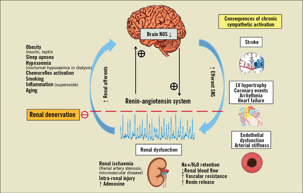 Chronic kidney disease role of sympathetic nervous system activation and potential benefits of