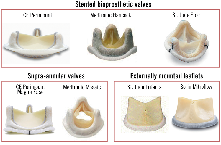 Failing Surgical Bioprosthesis In Aortic And Mitral Position ...