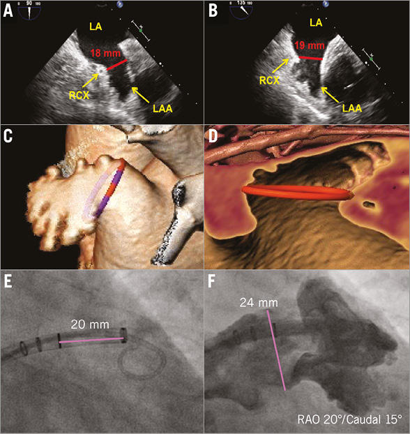 Left Atrial Appendage Closure: Patient, Device And Post-procedure Drug ...