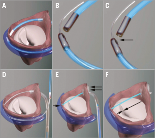 Emerging Technologies For Direct And Indirect Percutaneous Mitral